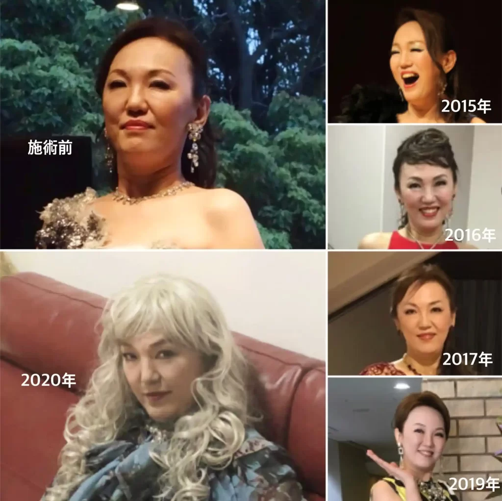 外山聖子さま施術ビフォーアフター