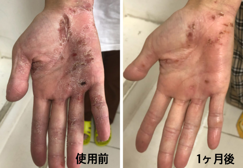 手荒れ、アトピー